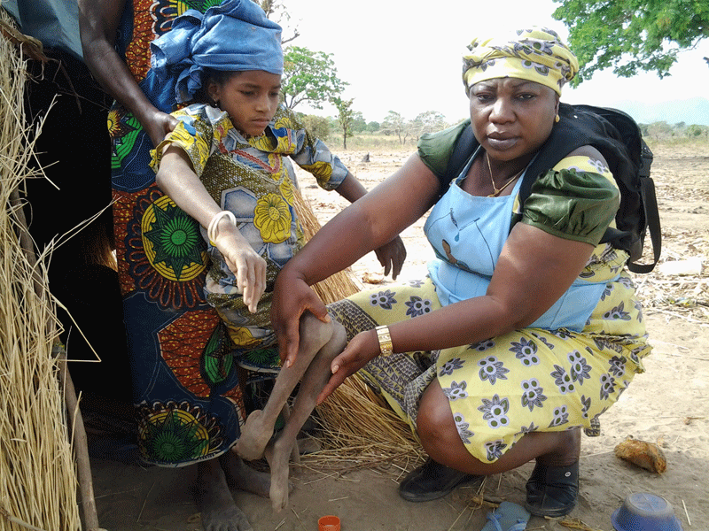 Ребёнок, переживший паралитический полиомиелит. Нигерия, 2014 год.