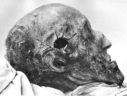 Прострелянный череп Карла XII