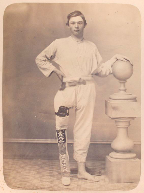 Протез ноги.jpg clothed-man-stands-facing-camera-shortened-right-leg-encas_3110014975_o.jpg