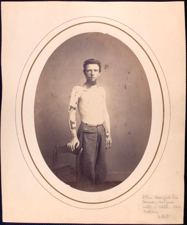 С протезом.jpg shirtless-man-standing-with-right-arm-in-brace-and-harnes_3110014849_o.jpg